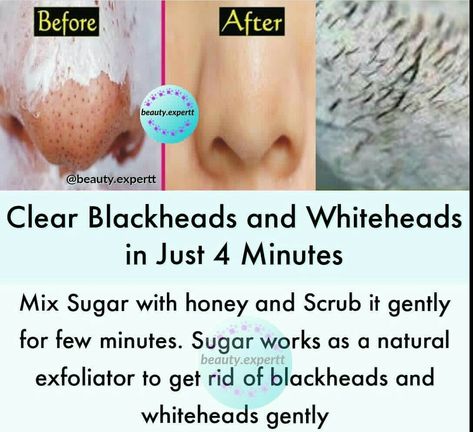 White Heads Removal, Clear Skin Remedies, Clear Skin Fast, Clear Blackheads, Clear Skin Face, Natural Face Skin Care, Good Skin Tips, Makeup Artist Tips, Skin Remedies