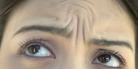 Erase Your "Angry" Wrinkles in a Snap Wrinkle Between Eyebrows, Hide Wrinkles, Chest Acne, Anti Aging Smoothie, Anti Aging Skin Care Diy, Forehead Acne, Get Rid Of Wrinkles, Anti Aging Face Serum, Anti Aging Secrets