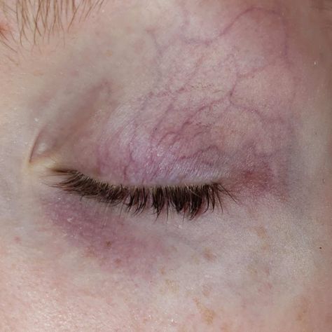 Veins Eye Makeup, Under Eye Veins, Veiny Eyelids, Eye Veins Makeup, Red Veins In Eyes, Veiny Skin, Body Details Aesthetic, Vein Makeup, Veins Face