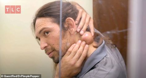 Man gets his 'painful softball-sized' lumps removed by Dr Pimple Popper | Daily Mail Online Arm Pimples, Boil Popping Videos, Neck Pimples, Hard Pimple, Deep Pimple, Ear Pimple, Inflamed Pimple, Painful Pimple, Big Pimple