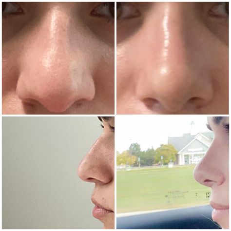 Nose Job Front Profile, Nose Job Front View, Perfect Nose Front View, Noise Job Perfect Nose, Bella Hadid Nose, Tip Plasty Nose, Nose Surgery Rhinoplasty, Nose Fillers, Thick Skin Bulbous Tip Rhinoplasty