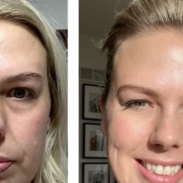 Dr. Kassie Dewitt, OTD on Instagram: "I added the Matrixyl 3000 anti aging serum twice a day to my skin care routine and love the results. The serum limits fine lines and firms the skin. I have already ordered my next bottle from Depology. The before and after picture was taken 4 weeks apart. Depology has given 10% off to anyone who uses the link in my comments. #wrinkles #depologyskincare #serum #antiaging #matrixyl3000 #skincareproducts" My Skin Care Routine, Skin Care Pictures, Matrixyl 3000, Pelvic Floor Exercises, Floor Exercises, Aging Serum, Anti Aging Serum, Pelvic Floor, My Skin