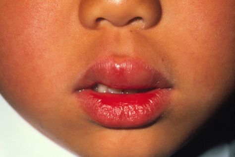 Allergic reaction Swollen upper lip of a six year-old boy who is experiencing an allergic reaction to peanuts. Eating peanuts has triggered ... Swollen Lip Remedy, Lip Allergy, Eita Semi, Shirabu Kenjiro, Swelling Remedies, Makeup Extreme, Hangover Headache, Swollen Lips, Sunburn Peeling