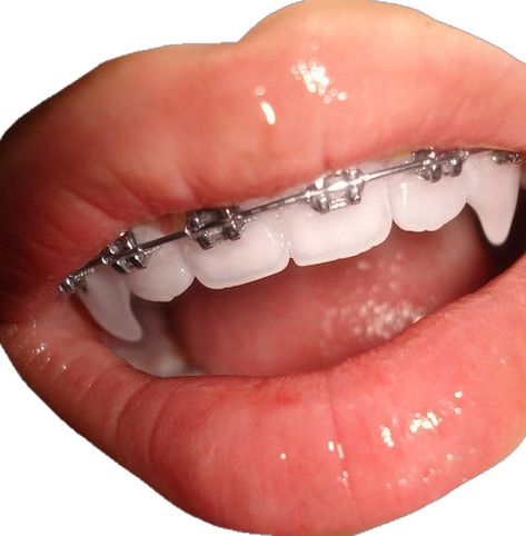 Braces Drawing, Silver Braces, Lips Aesthetic, Teeth Aesthetic, Teeth Bleaching, Dental Braces, Perfect Teeth, Teeth Braces