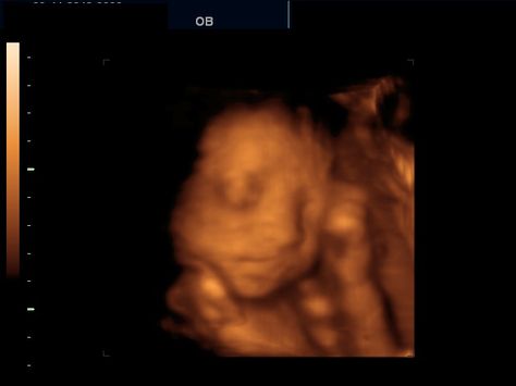 28 Weeks 3d Ultrasound Pictures, Ultrasound Studio, Gender Determination, Studio Pictures, 3d Ultrasound, Ultrasound Pictures, Ultrasound, How To Memorize Things, Quick Saves