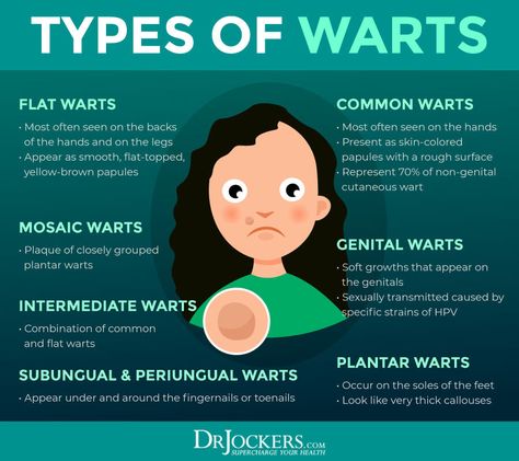 Filiform Wart, Flat Warts, Types Of Warts, Skin Wars, Home Remedies For Warts, Remove Skin Tags Naturally, Warts Remedy, Skin Moles, Mole Removal