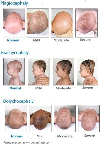 diagram of different levels of flat heads on baby Baby Head Shape, Flat Head Syndrome, Nursing School Essential, Health Chart, Baby Routine, Newborn Baby Tips, Newborn Mom, Nursing School Survival, Medical School Essentials