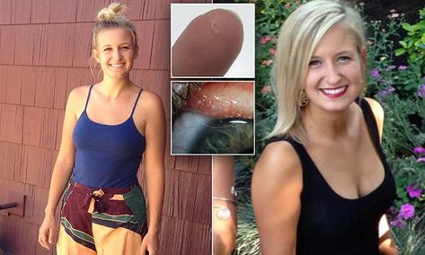 Woman, 26, diagnosed with first ever case of EYE WORMS found in humans Dewormer For Humans, Human Worms, Tape Worm In Humans, Natural Human Dewormer, Eye Worm, Pin Worms, Who Up Playing With Their Worm, Healthy Mind, Halter Dress