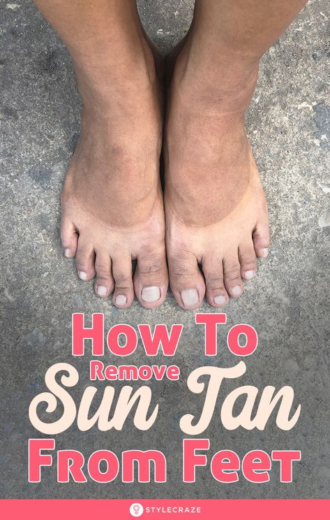 How To Remove Sunburn, Tan Removal Home Remedies, Feet Whitening, Get Rid Of Tan, Sun Tan Removal, Get Rid Of Sunburn, How To Get Tan, Tanning Tips, Tan Removal