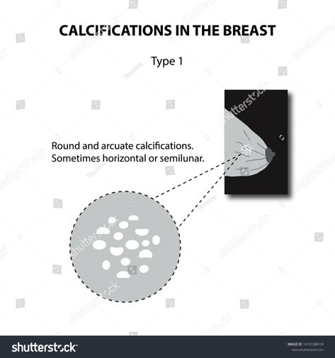 Calcifications in the breast. Mammography. The mammary gland. Infographics. illustration on isolated background #Ad , #AFF, #Mammography#mammary#Calcifications#breast Infographics Illustration, Mammary Gland, Study Materials, Greeting Card, Royalty Free Stock Photos, Typography, Greeting Cards, Stock Photos