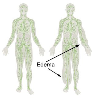 Lymphedema is a persistent swelling of the arm or leg.  It may occur after mastectomy, when lymph nodes are damaged or removed, following infection or scar formation which blocks the lymphatic fluid flow. Inflammation Remedies, Medical Library, Swollen Ankles, Lymph Massage, Lymph Drainage, New Rochelle, Compression Garment, Lymph Nodes, Cosmetic Surgery