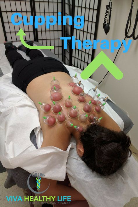 Cupping Therapy, #Hijama and #Acupuncture Philadelphia provided by Dr. Tsan; please contact Viva Healthy Life today to book the appointment for #Cupping Therapy in Philadelphia. Chinese Cupping, Acupressure Therapy, Cupping Therapy, Shiatsu Massage, Homeopathic Medicine, Alternative Treatments, Deep Tissue Massage, Skin Healing, Acupressure