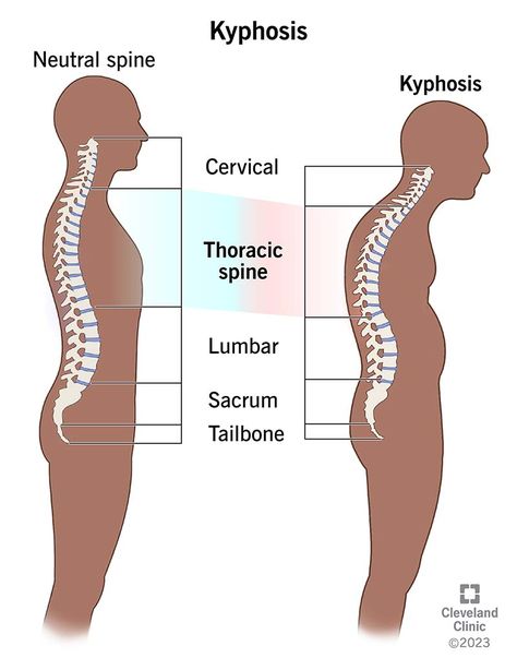 Kyphosis: What Is It? Back Brace For Posture, Medicine Anatomy, Anatomy Biology, Posture Stretches, Spinal Fusion Surgery, Forward Head Posture Exercises, Neck And Shoulder Muscles, Gross Anatomy, Forward Head Posture