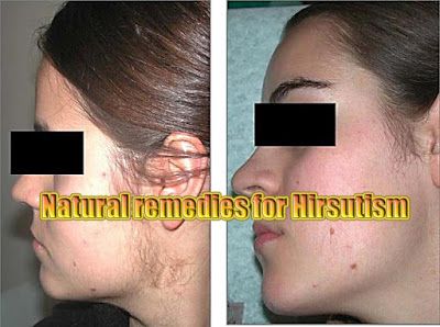 Home Remedies for Hirsutism, Home remedies for unwanted hair on face