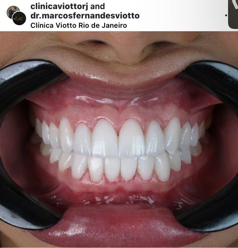 Porcelain Veneers by clinicicaviotorj and dr.marcosfernandesdesviotto in Rio de Janeiro. Ig @clinicaviotto Dental Morphology, Teeth Reference, Natural Veneers, Cute Short Bob, Composite Veneers, Dental Bonding, Face Routine, Porcelain Veneers, Perfect Teeth