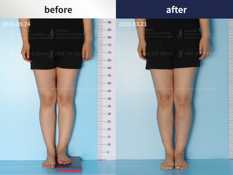 This patient treated 2.1cm of leg length discrepancy by undergoing the tibial lengthening surgery using PRECICE surgical method. PRECICE is not only useful for cosmetic leg lengthening surgery, but also treating the pathological condition such as leg length discrepancy. Leg Lift Surgery Before And After, Leg Lengthening Surgery, Porcelain Prosthetic Leg, Post Laparoscopic Surgery, Laparoscopic Surgery, Surgery, Conditioner