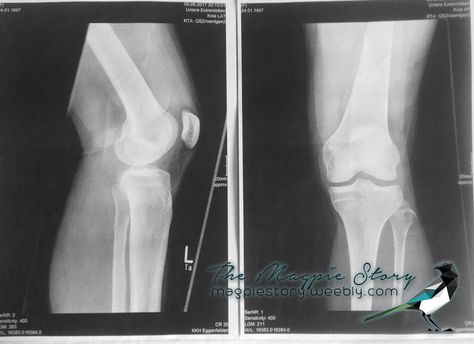 Left knee X-ray ... How to get an ACL & Meniscus injury right before your school exams ? #ACL , #ACLinjury , #ACLandmeniscus , #magpiestory Knee Sprain, Meniscus Injury, Netball, Knee Injury, X Ray, On Earth, Do It, Reading, Quick Saves