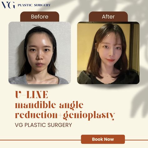 we specialize in V-line surgery - a procedure aimed at refining and slimifying the jawline to create a more harmonious and youthful face shape. V-line surgery can enhance your overall facial profile, making your face look more balanced and slender. V Shaped Jawline, Facial Profile, V Line Surgery, Youthful Face, V Line, Face Shape, Plastic Surgery, V Shape, Face Shapes