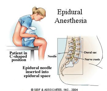 Epidural anesthesia is a regional anesthesia that blocks pain in a particular region of the body. The goal of an epidural is to provide analgesia, or pain relief, rather than anesthesia, which leads to total lack of feeling. Epidurals block the nerve impulses from the lower spinal segments. Spinal Anesthesia, Epidural Needle, Labor At Home, The Nerve, Infant Adoption, Give Birth, How To Give, Medical Illustration, Caregiver