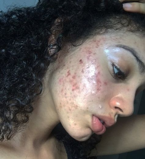 Model 'clears up severe acne in a week with this natural skincare routine' | Metro News Acne Skincare Routine, Severe Acne, Natural Acne, Natural Acne Remedies, Natural Skin Care Routine, Acne Remedies, Acne Skin, Natural Beauty Tips, Skincare Tips