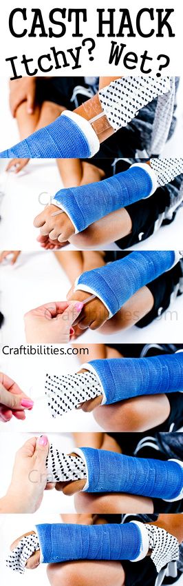 Itchy cast? Wet cast? This helps relieve an itchy spot or help soak up excess water or at least put something between the wet cast and skin. Cast Designs Arm, Cast Art Arm, Crutches Workout, Arm Cast Decorating Ideas, Cast Colors, Tattoo Back Of Arm, Arm Cast, Cast Covers, Leg Cast