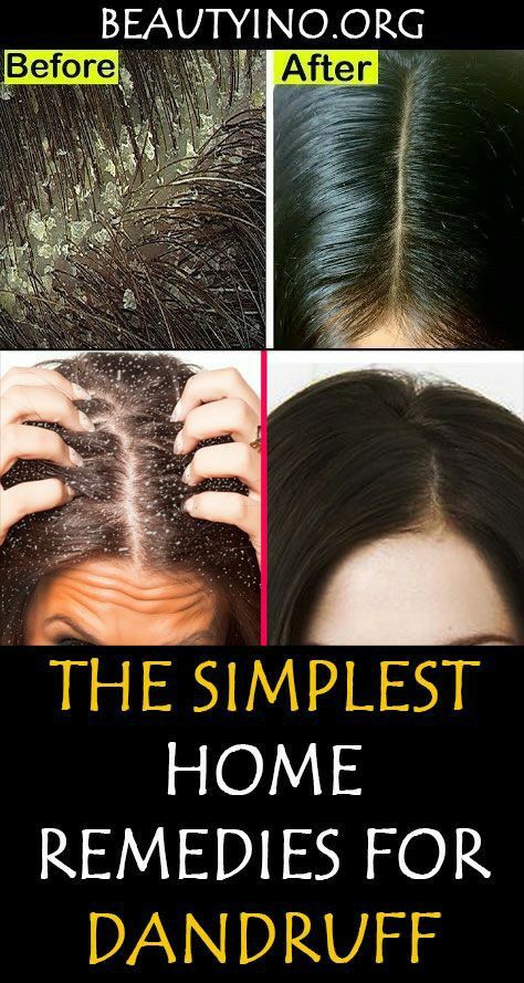 Diy Hair Mask For Dandruff, White Scales, Hair Mask For Dandruff, Dandruff Causes, Dandruff Solutions, Home Remedies For Dandruff, Best Hair Growth Oil, Dandruff Remedy, Getting Rid Of Dandruff