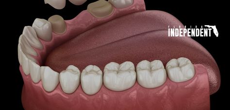 Are you the type who refuses to smile because of your missing teeth? A dental bridge is an… The post What to Know Before Getting a Dental Bridge appeared first on Florida Independent 🌈. Dental Bridge Before And After, Tooth Bridge, Cantilever Bridge, Temporary Tooth, False Teeth, Missing Teeth, Dental Bridge, Tooth Enamel, Tooth Extraction