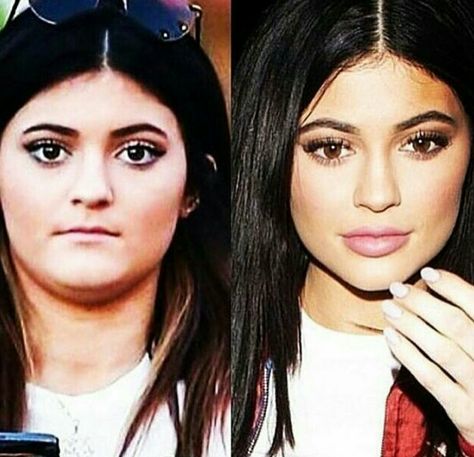 Kylie Jenner's plastic surgery Kim Before And After Surgery, Kylie Jenner Ugly, Kylie Jenner Without Makeup, Kylie Jenner Plastic Surgery, Ugly Makeup, Jaw Reduction Surgery, Celebrity Surgery, Face Plastic Surgery, Plastic Surgery Fail