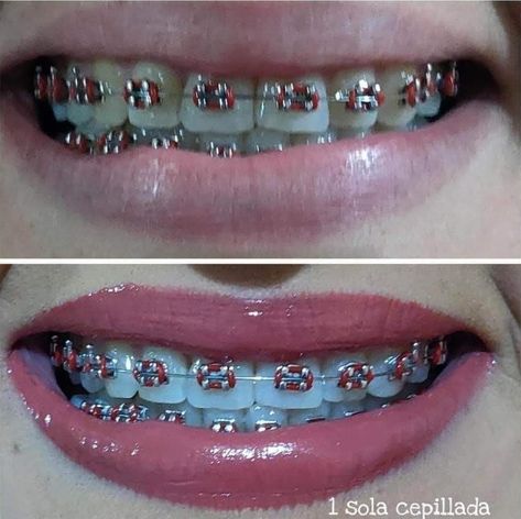 Perfect Teeth Braces, Dental Braces Colors, Gold Braces, Braces Bands, Cute Braces Colors, Types Of Braces, Braces Tips, Getting Braces, Cute Braces