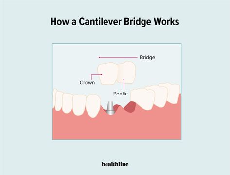 Cantilever Dental Bridge: Benefits, Drawbacks, and How it Works Tooth Bridge, Cantilever Bridge, Temporary Crown, Akuma No Riddle, Teeth Alignment, Partial Dentures, Tooth Replacement, Dental Bridge, First Tooth