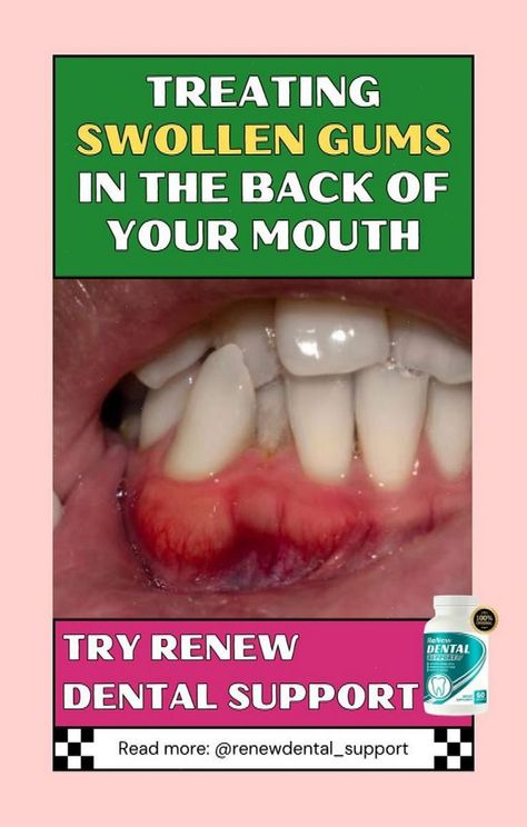 Discover effective methods for gum care and how to treat swollen gums naturally. Learn gum health tips to rebuild gum lines, grow back receding gums naturally, and reverse receding gums with home remedies. Find out how to get rid of bleeding gums and ensure stronger and healthier gums. This guide covers essential dental advice for perfect teeth, teeth remineralization, and tackling ...#Tips #Wellness #Stimulate #HealthTips #Gums #Naturally #to #NutritionTips #How #Regrowth #Receding #Gum #for Reverse Receding Gums, Grow Back Receding Gums, Heal Cavities, Swollen Gum, Perfect Teeth, Teeth Health, Receding Gums, Gum Care, Gum Health