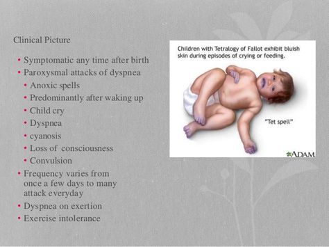 Tetralogy Of Fallot Nursing, Tetralogy Of Fallot, Crna School, Heart Structure, Heart Defect, Visual Learning, After Birth, Nursing Study, Med Student