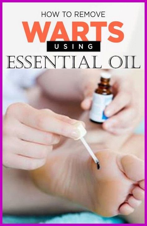 How To Remove Warts & Infection Using Essential Oil How To Remove Warts, Remove Warts, Home Medicine, Cold Medicine, Health Articles Wellness, Steam Distillation, Natural Healing Remedies, Cold Sores Remedies, Natural Health Care