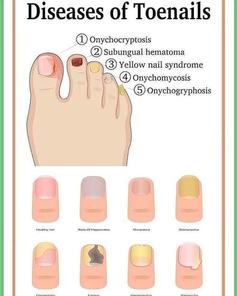 Medical Points on Instagram: "A nail disease or onychosis is a disease or deformity of the nail. Although the nail is a structure produced by the skin and is a skin appendage, nail diseases have a distinct classification as they have their own signs and symptoms which may relate to other medical conditions. Some nail conditions that show signs of infection or inflammation may require medical assistance. Credits: @medicine__World #nail #toenail #toenaildiesease #yellownails" Toe Nail Colors, Nail Disorders, Nail Remedies, Nail Tech School, Nail Care Diy, Nail Conditions, Nail Infection, Weak Nails, Toe Nail Color