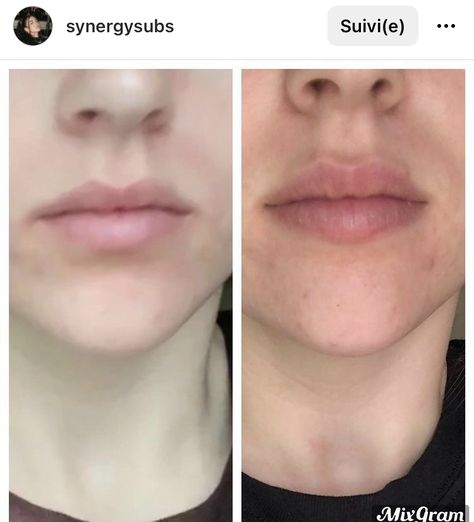 Lips Subliminal Results, Ski Slope Nose, Slope Nose, Subliminal Results, Drink A Lot Of Water, Asian Makeup Looks, Ski Slope, Plump Lips, Hips Dips