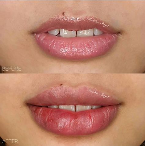 Bottom Lip Filler, Heavy Bottom Lip, Long Philtrum, Lip Filler Technique, Best Laser Hair Removal, Lip Augmentation, Lip Filler, Lip Enhancement, Bottom Lip