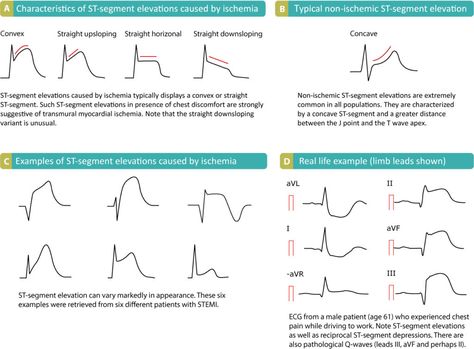 ECG interpretation: Characteristics of the normal ECG (P-wave, QRS complex, ST segment, T-wave) – ECG & ECHO Ecg Reading, Myocardial Ischemia, Brugada Syndrome, Normal Ecg, St Elevation, Ecg Interpretation, Pr Interval, Acute Coronary Syndrome, Differential Diagnosis