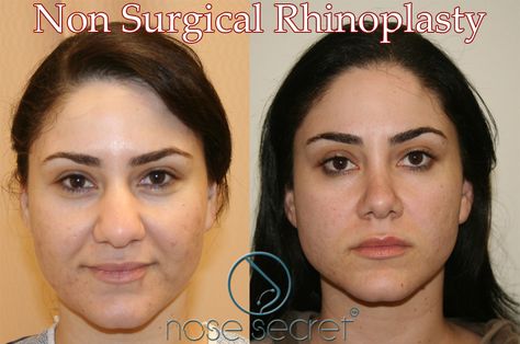 Non Surgical Nose Job For Wide Nose - NoseSecret comprises of a couple of bended and agreeable props that you put at within edge of every nostril to make your nose look smaller and straighter,instantly. Nostril Reduction, Non Surgical Nose Job, Nonsurgical Nose Job, Nose Reshaping, Rhinoplasty Nose Jobs, Rhinoplasty Before And After, Nose Jobs, Wide Nose, Lip Art Makeup