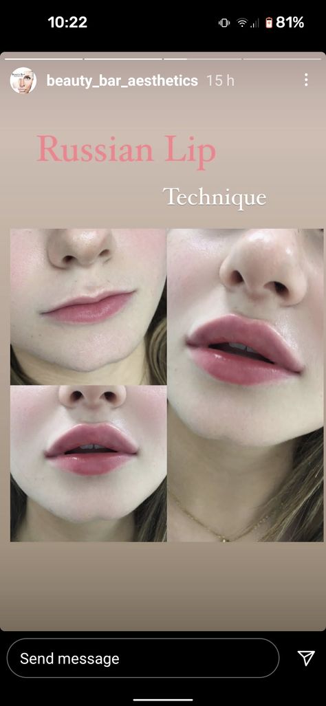 Round Lips Aesthetic, Lip Filler Round Lips, Lip Injections Aesthetic, Hollywood Lips Filler, M Shaped Lips, Korean Lip Filler, Round Lips Filler, Lip Filler Russian, Russian Lip Filler Technique