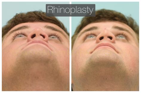 This 25-year-old is shown seven weeks after a rhinoplasty with Dr. Lam. He had trauma to his nose from sports as a teenager and difficulty breathing from the left side of his nose and did not like how asymmetric his nasal tip, bridge, and nasal base appear. He also has a saddle nose deformity with a collapse nasal bridge. 📞972-312-8188 ⠀ ⠀ ⠀ ⠀ 🌎 www.lamfacialplastics.com ⠀ ⠀ ⠀ ⠀ 📩 info@lamfacialplastics.com ⠀ ⠀ ⠀ ⠀ 📍6101 Chapel Hill Boulevard, Suite 101, Plano, Texas 75093 ⠀ ⠀ ⠀ ⠀ ⠀ Rhinoplasty Surgery, Difficulty Breathing, Nose Surgery, Scientific Articles, Plano Texas, Facial Plastic, Nose Job, Chapel Hill, 25 Years Old