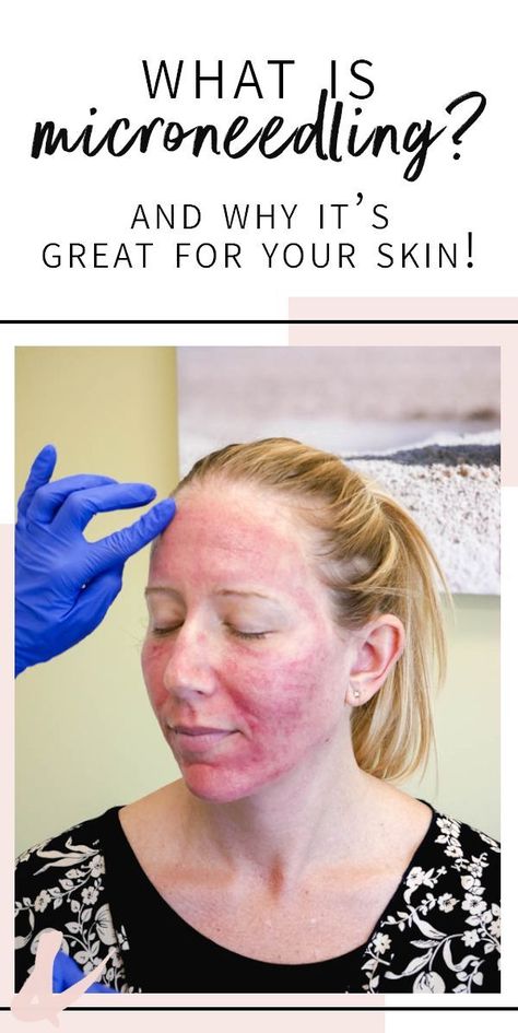 What is microneedling and what benefits will it bring to your skin. Sharing my experience, including before and after pictures of my face, as I try to smooth out my acne scars. I highly recommend seeing a professional for micro needling with prp! #microneedling #acnescars #cupcakesandcutlery #beauty Derma Roller Before And After, Prp Microneedling, Micro Needling, Acne Scar, Acne Scar Removal, Natural Cough Remedies, Derma Roller, Scar Removal, Acne Remedies