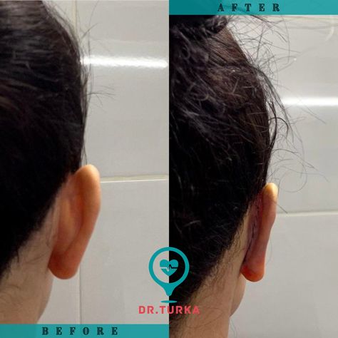 ✨Our dear patient from Malta���🇲🇹had achieved Otoplasty (Cosmetic Ear Surgery). * 📲 +90 552633999 📩info@drturka.com 🌐www.drturka.com * #otoplasty #otoplastia👂 #otoplastia #otoplastysurgery #otoplastybeforeandafter #otoplastyturkey #earsurgerycosmetic #earsurgeryturkey #earssurgery #otoplastica #otoplastía #earsurgerycosmetic #otoplastyka #otoplasti #otoplastyistanbul Ears Pinned Back Before And After, Ear Surgery, Plastic Surgery, Malta, Surgery, Vision Board, Pasta, Quick Saves