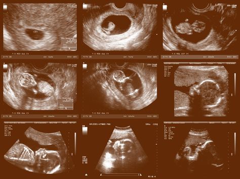 10 Week Ultrasound Pictures, 12 Weeks Pregnant Ultrasound, 8 Weeks Pregnant Ultrasound, 10 Week Ultrasound, 3d Ultrasound Pictures, 12 Week Scan, Pregnancy Development, Obstetric Ultrasound, 12 Weeks Pregnant