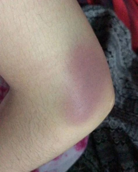 Scars Over Hands, Bp Low Hospital Snap, Injured Leg Snap, Knee Wound Fake Story, Leg Injury Snapchat Streaks, Leg Accident Real Pic, Knee Injury Snapchat, Injured Leg Snapchat, Pap Kecelakaan Motor