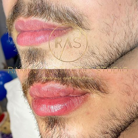 We have created a natural looking lip plump for our handsome patient. 1ml Restylane used to achieve the result
Lip filler before and after Mens Lip Filler, Men Lips, Cosmetic Nurse, Juvederm Lips, Botox Before And After, Botox Lips, Chin Exercises, Cheek Fillers, Aesthetic Studio