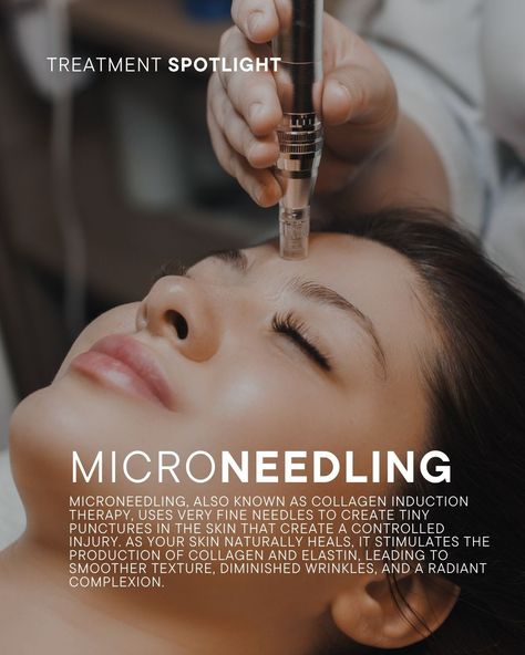 Collagen Induction Therapy, Microneedling Benefits, Facial Benefits, Esthetician Inspiration, Skin Poster, Health Zone, Bb Glow, Esthetics Room, Skin Facts