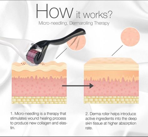 Derma Roller Results, Derma Rolling, Skin Tissue, Derma Roller, Facial Roller, Skin Clinic, Healthy Skin Tips, Healing Process, Loose Powder