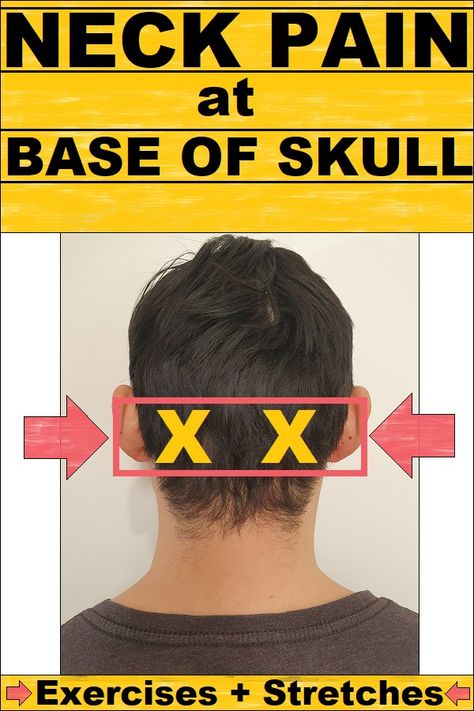 Neck pain at base of skull Neck Pain Exercises, Neck And Shoulder Exercises, Forward Head Posture Exercises, Neck And Shoulder Muscles, Neck Relief, Forward Head Posture, Head Pain, Neck Exercises, Back Stretches For Pain