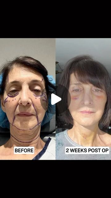 49K views · 2.7K likes | Dr. Rady Rahban | Beverly Hills: Board Certified Plastic Surgeon on Instagram: "What is recovery like after a full facial rejuvenation? Take a look at this incredible result just 2 WEEKS post-op! She was gracious to share her journey with you all after undergoing the following: - Full Deep Plane Facelift - Brow Lift - Lower Blepharoplasty with fat repositioning Our beautiful patient came to us looking for a natural, full rejuvenation of her face. Throughout one’s life, the sun’s radiation, stress, gravity, and other factors cause the skin to age making individuals “look older” than they feel on the inside. To help accomplish a natural result, I performed a deep plane facelift, brow lift, lower Blepharoplasty with fat repositioning to address the laxity that h Lower Face Lift, Deep Plane Facelift, Facial Rejuvenation, Brow Lift, Post Op, In Your Face, Look Older, Plastic Surgeon, Beverly Hills