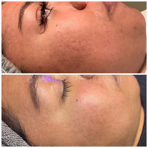 Ruma Aesthetics, Microneedling Before And After, Get Clear Skin Fast, Acne Prone Skin Care Routine, Clear Skin Fast, Acne Prone Skin Care, Get Clear Skin, Aesthetic 2023, Best Hair Transplant